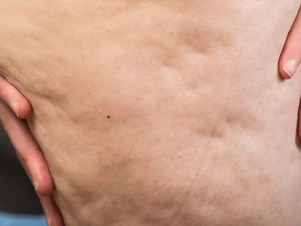 Stadi del lipedema: dalla diagnosi alla gestione
